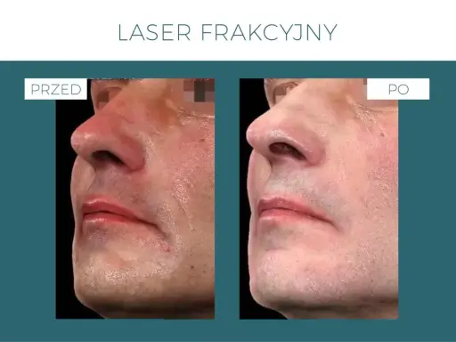 Laser frakcyjny: Skutki uboczne? Co jest normą, a co alarmem?