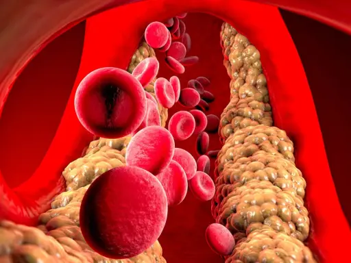Wysoki cholesterol: Czy masz te objawy? Sprawdź, zanim będzie za późno.