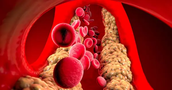Wysoki cholesterol: Czy masz te objawy? Sprawdź, zanim będzie za późno.