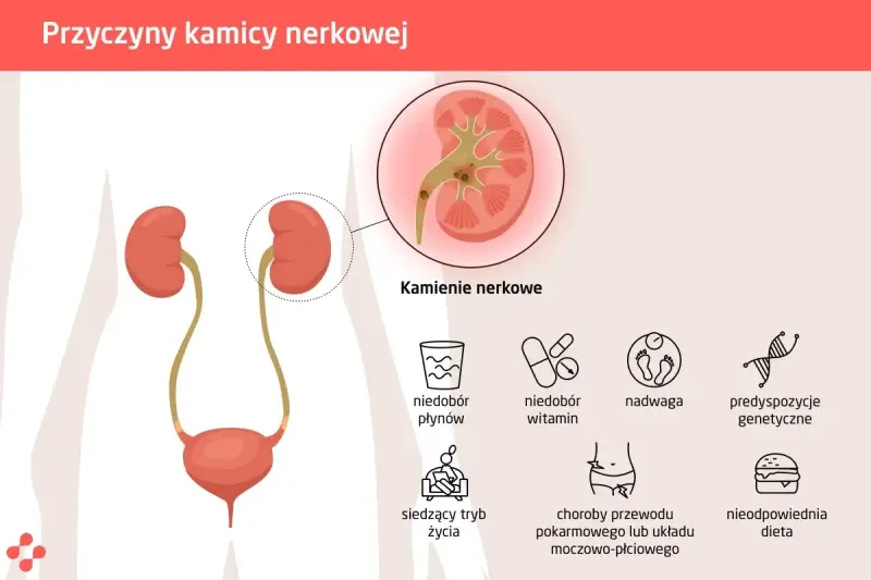Kolka nerkowa: objawy, ból nie do zniesienia? Kiedy pilnie do szpitala?
